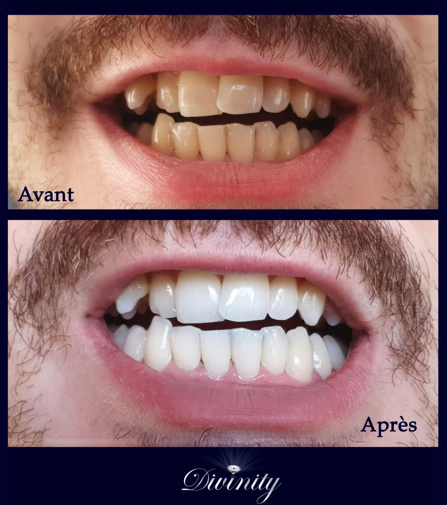 Avant/ Après