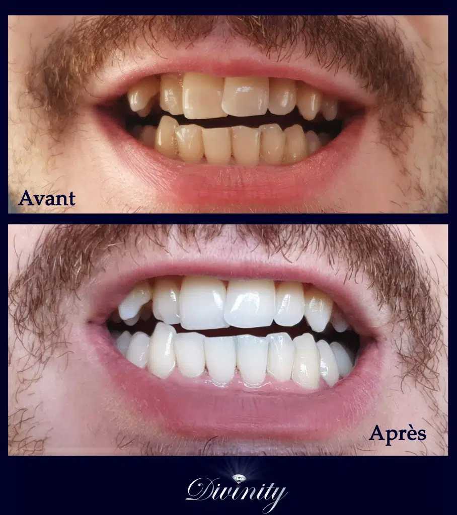 Avant/ Après